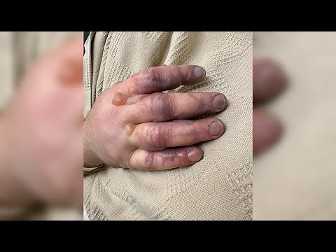 Hyperbaric Oxygen Therapy Used for Man’s Frostbitten Fingers