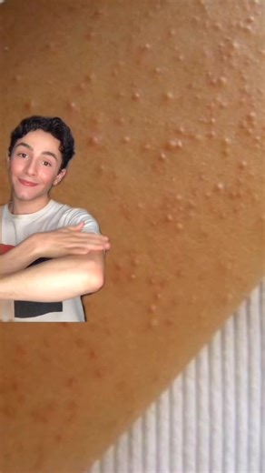 Urea Repair Plus ➡️ une bonne solution contre la kératose pilaire ☺️ #Eucerin #Urearepair #peau #skincare -ad