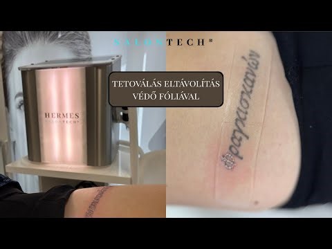 Tetoválás eltávolítás védő fóliával