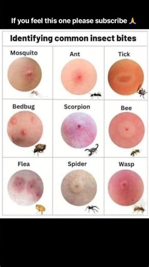 Don’t Ignore These Insect Bites! 😳🕷️ #Shorts #views #viral #trending #usa #video