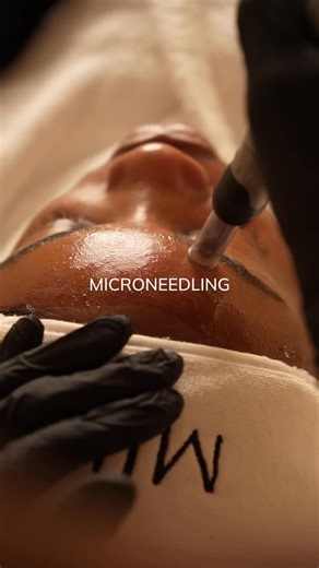Cosmetology | Slimming | Botox & Fillers | Hair loss on Instagram: "Microneedling — a refined way to renew your skin 👩🏻‍⚕️ Microneedling is an advanced skin rejuvenation treatment that activates the skin’s natural ability to repair and renew itself. By creating controlled micro-channels, the procedure stimulates collagen and elastin production, improving skin quality from within. Why microneedling is loved: — improves skin texture and tone — reduces the appearance of fine lines and enlarged po