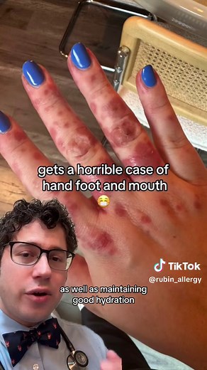 @Syd 🤎 Lifestyle • Mama What is hand, foot, and mouth disease? What are the signs and symptoms of hand, foot, and mouth disease? How is hand, foot, and mouth disease treated? How to prevent hand, foot, and mouth disease? #handfootandmouthdisease #rash #tiktokdoc #parentsoftiktok #learnontiktok