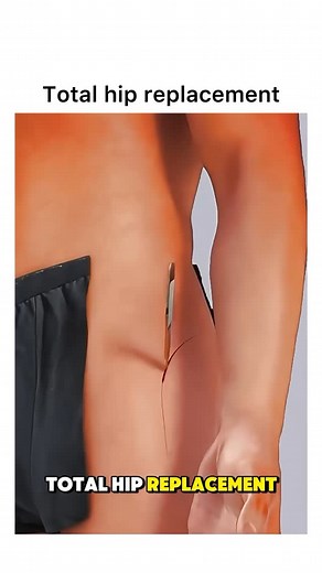 Animations on Instagram: "Follow @surgicalanimation for more! 🏥"