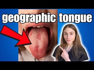 Discover The Root Causes Of Geographic Tongue!