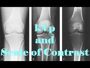 ⚡CONTRAST (PART 1-Relationship between kVp and Scale of Contrast)
