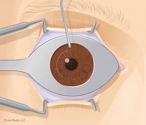 27K views · 105 reactions | LASIK Surgery Explanation | Doctors | Facebook