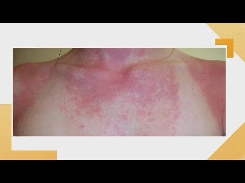 Avoiding skin problems caused by sun exposure