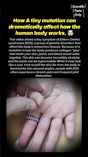 Watch The Rare Genetic Condition That Makes Skin Stretch Like : EDS 🤯 #science #medical #genetics