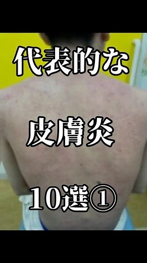 代表的な皮膚炎10選① #皮膚炎 #湿疹 #肌荒れ #アトピー #スキンケア