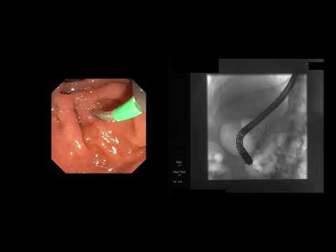 ERCP: position, cannulation, sphincterotomy and sweeping