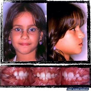 Serial Extractions - Part 2 LONG TERM STABILITY The aim of the serial extraction treatment is to create space in the mixed dentition for the eruption of permanent teeth in more favorable positions on the basal bone to prevent or reduce the complexity of future orthodontic treatment in permanent dentition. In general, it is indicated in class I cases with crowding of a genetic etiology, starting in the first transitional period of mixed dentition. This is a procedure that requires a solid knowled