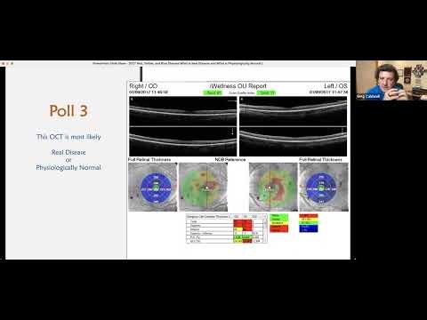 OCT Interpretation – Red Yellow and Blue Disease, What is Real Disease, and What is Physiologically
