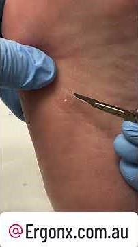 Ultimate Foot Relief: Corn & Callus Removal by Expert Podiatrist #PodiatryCare #FootHealth