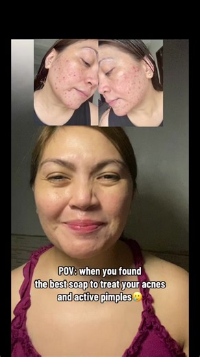 Discover the Best Soap for Acne-Prone Skin