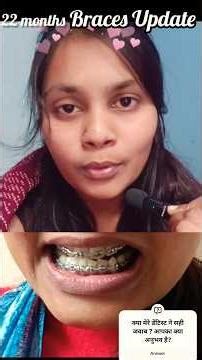 Braces Update⚠️ 22 months completed #braces #braceslife #bracesjourney
