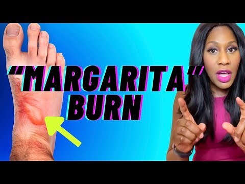 The DANGER of CITRUS & the SUN: ‘MARGARITA BURN?’ Doctor Explains Phytophotodermatitis