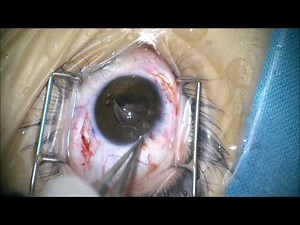 Scleral sutured foldable IOL through 2.2 corneal incision