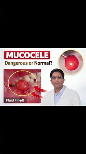 mucocele #dentist #smiledesigndental #yaskodentalhospital#lowerlip#SalivaryGland #MucoceleTreatment