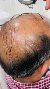 376K views · 2.9K reactions | Hair loss treatment #hairlosstreatment #hairloss #Haircare #reelsviral #reelkarofeelkaro #hair #poonamhairlounge | Poonam Anand | Facebook