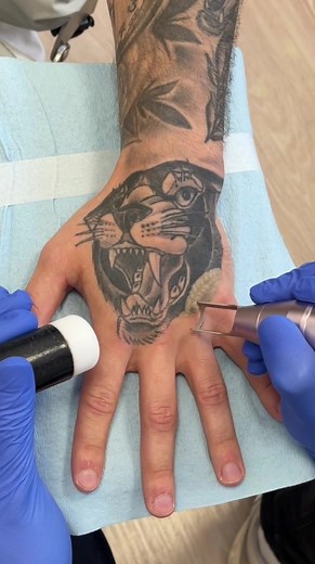 Laser Tattoo Removal Process Explained