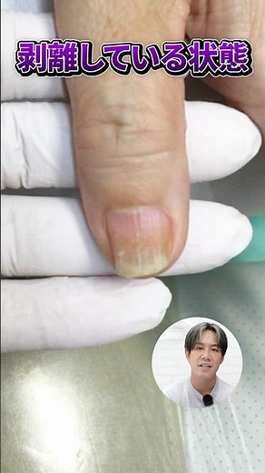 【女性は要注意】ジェルネイルが原因で起こりやすい手の爪の剥離