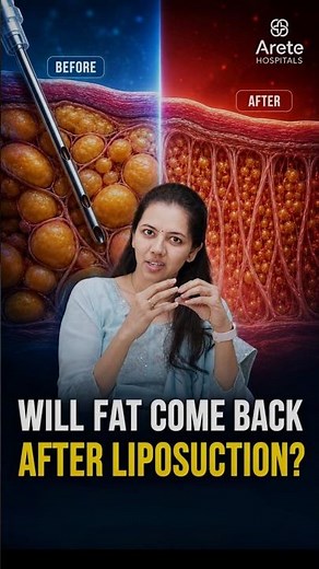 Liposuction Explained: Will Fat Come Back After Surgery? | Dr. Sindhuri | Arete Hospitals