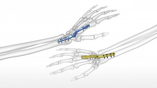 Total Wrist Fusion Plating System
