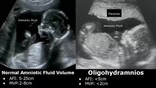 Obstetric Ultrasound Normal Vs Abnormal Images Fetal Placenta Umbilical Cord Pathologies Usg Dr Sam S Imaging Library Mp3 & Mp4 Download - clip.africa.com