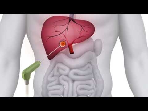 What is Microwave Ablation (MWA)? And how it works?