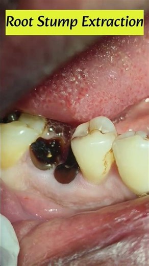 Easy Premolar Stump Removal Technique#shorts #bds #bdslife #dental #dentalclinic #extraction