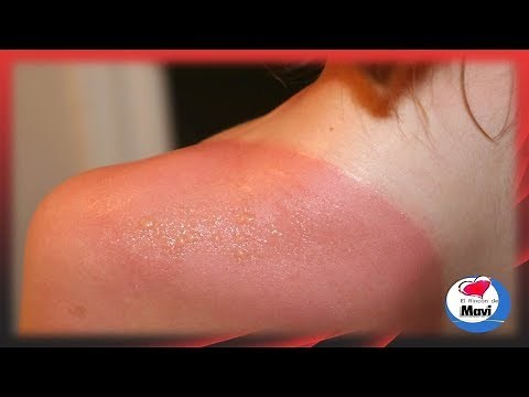 Como Quitar Lo Quemado Del Sol En Un Dia 🙈 Curaciones Para Quemaduras