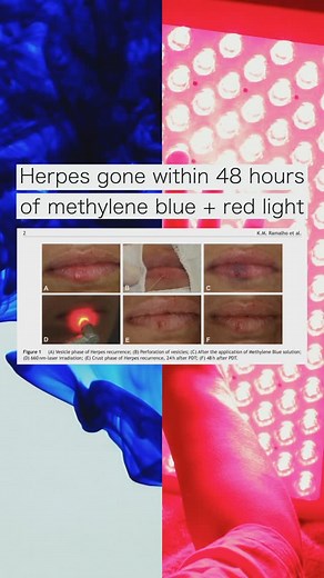 7.7K views · 15 comments | Methylene blue is applied via cotton swab, wait 5 minutes, then red light application for ~2 mins. This has also been documented with sunlight instead of red light. The combo is a powerful antimicrobial mix. #methyleneblue #redlighttherapy #herpes #coldsore #coldsoreremedy | Analyze & Optimize | Facebook