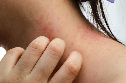 How to Relieve Contact Dermatitis