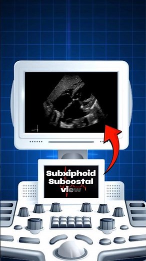 2D Echo: Subxiphoid View Explained! 🫀📡 #Cardiology #Echocardiography