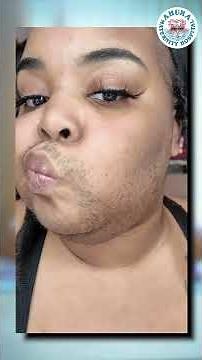 PCOD Explained by Gynecologist | Symptoms, Causes & Treatment Every Woman Must Know