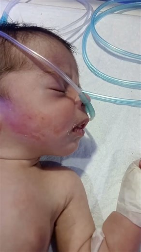 #NewbornBronchiolitis#NebulizerProtocol#NICUNewborn#NeonatalCare#RespiratoryCare#NewbornBaby#