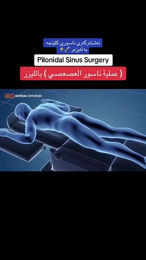 Pilonidal Sinus Surgery with Laser Treatment