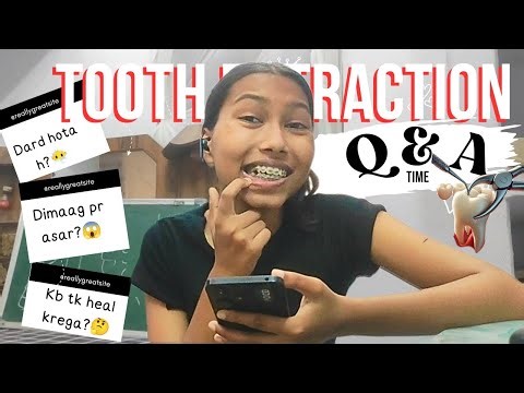🦷TOOTH EXTRACTION Q&A : Everything You Need to Know!