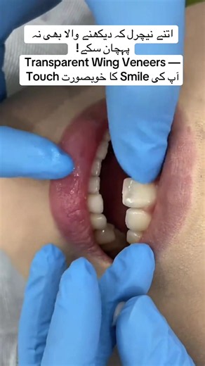 #prepveneers #drhaqjanofficial1 #HAQJANDENTALCLINIC🦷 #pleaseunfreezemyacount #viralvideoforyou @Dr Saima Khan
