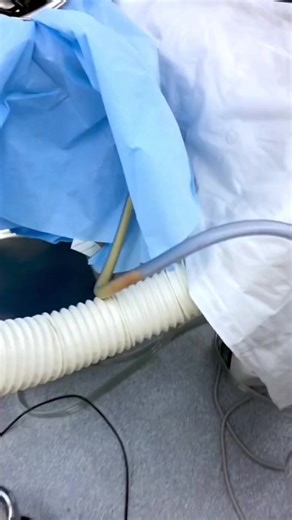 Más información sobre la reducción de grasa por ultrasonidos | Brandex