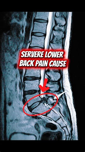 Sciatica from an L5–S1 disc extrusion compressing the S1 nerve root #sciatica #osteopathy #pain