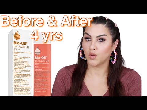 Bio Oil Before & After 4 Years Later