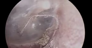 Doctors find spider building a nest inside a man’s ear, examination video goes viral