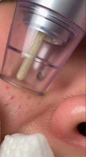 Satisfying Blackhead Removal: Deep Clean Your Pores with This Amazing Tool!
