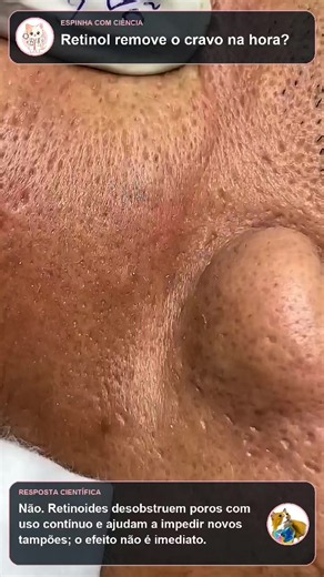 Retinol: O Ativo Poderoso Contra Acne e Envelhecimento da Pele