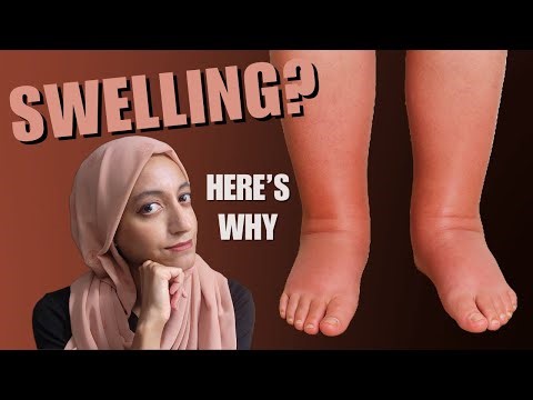 Is Leg Swelling Dangerous or Normal? Depends