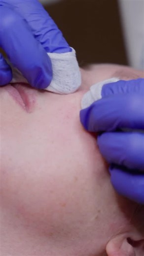 James Vivian on Instagram: "Is it milia or a breakout? Here’s how to find out! Milia are small, white or yellowish bumps that form as small cysts due to a collection of protein under the skin. They are usually found around the eyes, the nose and cheeks but can also be found on the body. Milia are harder to the touch than a breakout and are really tricky to extract. The removal of them will usually require professional help and a small piercing of the skin before a squeeze. The good news? They’re