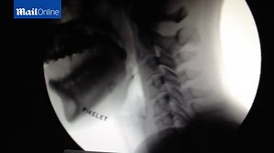 X-ray shows how Samantha's manual swallow technique