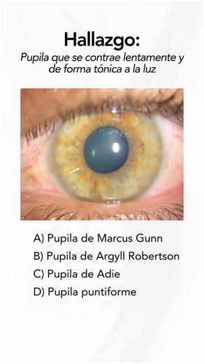 qENARM on Instagram: "¿Cuál sería tu diagnóstico al encontrar una pupila que no reacciona a la luz, pero sí acomoda y converge? . . . B) La pupila de Argyll Robertson es un hallazgo neurológico caracterizado por miosis bilateral, pupilas irregulares y disociación luz-cercanía: pierde el reflejo fotomotor (directo y consensual), pero conserva la respuesta a la acomodación/convergencia. Se asocia clásicamente a neurosífilis (tabes dorsal), aunque puede verse en otras lesiones del mesencéfalo dorsa