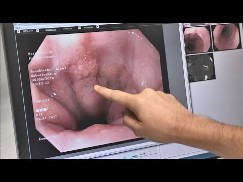 Speiseröhrenkrebs - TVA Gesundheitsforum